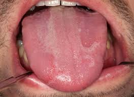 Auch wenn sie gelegentlich wie pickel auf der hautoberfläche aussehen. Wund Im Mund Es Ist Zum Gluck Nicht Immer Krebs Zwp Online Das Nachrichtenportal Fur Die Dentalbranche