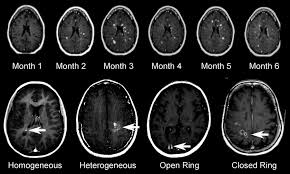 Multiple sclerosis has a fascinating geographic distribution: The Use Of Magnetic Resonance Imaging In The Diagnosis And Long Term Management Of Multiple Sclerosis Neurology