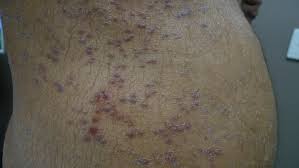 If you have this infection, you may experience irritated, dry patches on your skin, and excruciating, burning wounds in your mouth and vagina. Acd A Z Of Skin Lichen Planus