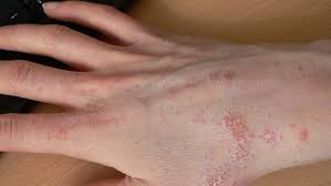 Image result for scabies norvegica