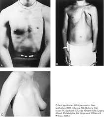 Poland syndrome is a rare anatomic defect caused by a malformation of the homolateral hand and manifests as the absence of the pectoral muscle. Breast Disease Basicmedical Key