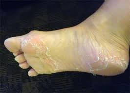 Most of the time a medium peel is enough to. Dead Skin Under Cast