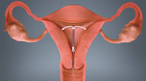 What happens if a iud or intrauterine device is a birth control method for women. Why Aren T Iuds As Popular As They Should Be Scientific Animations