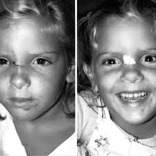 Left) Preoperative view of a young patient with a wound