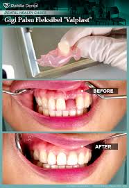 Maybe you would like to learn more about one of these? Gigi Palsu Valplast Klinik Pergigian Dahlia Facebook
