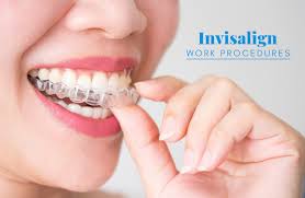 How fast do teeth move? A Guide To Invisalign How Does Invisalign Work