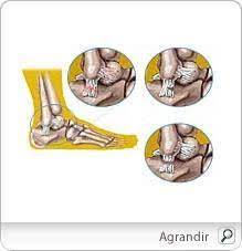 Lionnel.fr » style homme » comment se faire une entorse du genou ? Entorse Comment Soigner Une Entorse Duree Du Traitement