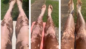 Image result for Pigment stains on the shin