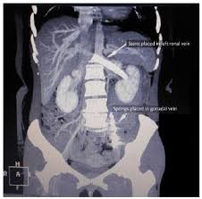 Endovascular Treatment Of Nutcracker Syndrome