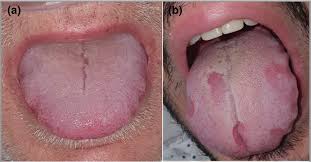 Maybe you would like to learn more about one of these? What Is Covid Tongue And Is It A Sign You Ve Been Infected With The Virus Health Com