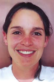 Smiling Frontal View example