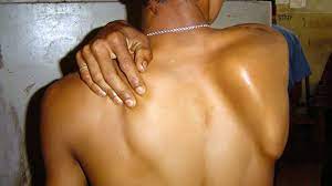 We did not find results for: Scapular Winging Symptoms Treatments And Exercises