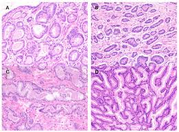 Image result for Prostate Cancer Histologic grading