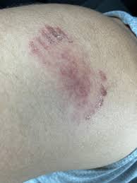 Image result for Human Bite