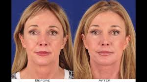Facial Slimming Injections & Treatments Sydney