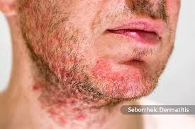 Image result for skin rash acute hiv infection