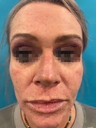 Opus® (Plasma) Before & After Photos