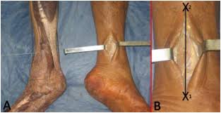 The flexor hallucis longus muscle tendon unit starts from the back of your leg. Descripcion Morfologica Del Musculo Flexor Largo Accesorio De Los Dedos Y Su Significancia Clinica