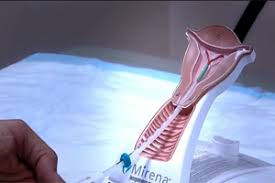 Thins the lining of the uterus and partially suppresses ovulation mirena prevents pregnancy for up to five years after insertion. Mirena Lawsuits Mirena Settlements Consumer Alert Now