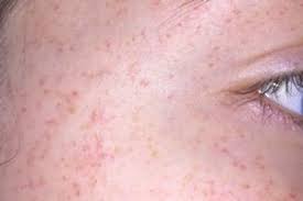 #purpura ist definiert als exanthem aus petechien. Rote Punkte Im Gesicht Meiner 15 Jahrigen Tochter Forum Gesundheit Medizin Urbia De