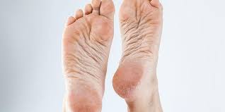 Kulit kering adalah kondisi yang umum terjadi. 16 Cara Menghilangkan Kaki Pecah Pecah Yang Paling Ampuh