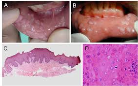 Image result for papillomavirus tongue)