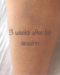 A laser hair removal treatment leaves the skin sensitive and a bit irritated. After 5 Sessions Of Laser Hair Gemma S Beauty Parlour Facebook