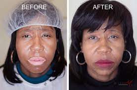 Loss Of Pigment In The Skin Due To Vitiligo Can Be Treated With Microart Colors Are Custom Blended And Applied In Micro Layers Un Vitiligo Skin Vitiligo Cure