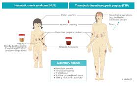 Image result for Plasmic Score