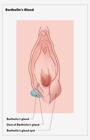 Image result for Bartholin's gland abscess