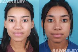 Rhinoplasty Procedure Before And After Rawnsley Plastic Surgery Rhinoplasty Nose Jobs Nose Surgery Rhinoplasty Rhinoplasty Before And After