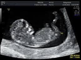 The scanning and display of ultrasound images are run at a sufficiently rapid rate so that moving structures can be viewed moving at their natural rate. Dating Reassurance Scans Babyvision