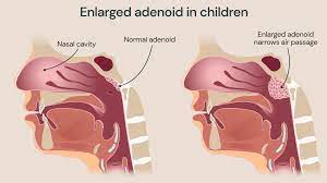 Adenoidectomy in children - Guys and St Thomas Specialist Care
