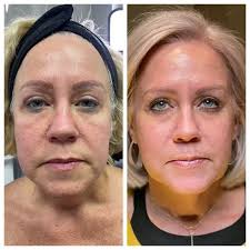 We offer a wide variety of services and products to help keep you feeling and looking young. Smoothglo Find A Laser Resurfacing Treatment Near Me Lumenis