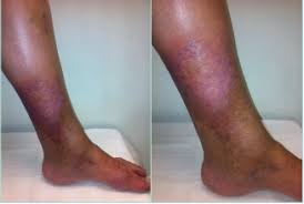 Image result for Lipodermatosclerosis