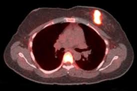 Puted tomography (ct) scan, able to detect lesions as. Pet Imaging Reveals Which Breast Cancer Patients Won T Respond To Hormone Therapy