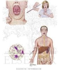 Infectious mononucleosis with atypical manifestations accompanied by transient igm antibody response for cytomegalovirus /j infect chemother. Infectious Mononucleosis