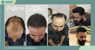 The hair loss clinic in turkey provides remedies for hair loss at reasonable costs when compared to those of european countries. Hair Transplant In Turkey Reviews Avrupa Sacekimi