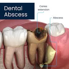 Image result for Periodontal Abscess