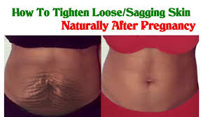 If a woman was overweight for a long time, the skin on the entire body has had time to stretch out. How I Tighten Loose Sagging Belly Skin After Pregnancy This Is Fastest Natural Method Youtube