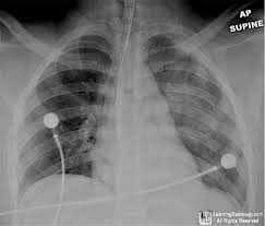 Image result for Flail Chest