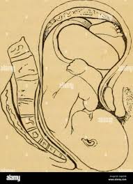 Image result for Manual Rotation in Occipitoposterior Presentation