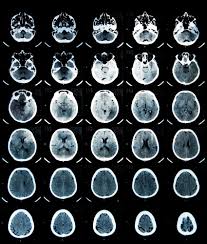 Check spelling or type a new query. Comotia Cerebrala