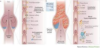 Venous Thrombosis Nature Reviews Disease Primers