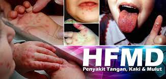 Penyakit tangan, kaki dan mulut. Penyakit Tangan Kaki Dan Mulut Hfmd Atul Hamid