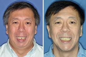 Sound sleep, thanks to jaw surgery, braces