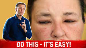 In This Video I Discuss How To Fix A Puffy And Swollen Face Dr Berg Swollen Face Health And Wellness Center