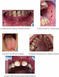 Image result for Labial mucosa