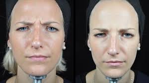 How long for botox to work. The New Baby Botox This Is Exactly What Happens To Your Face Healthista