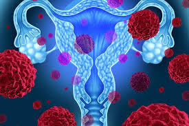 Amal dr4 kapsulkini keadaan pulih sepenuhnya kanser usus merupakan antara kanser yang tertinggi di malaysiatonton sampai habis jika anda atau ada keluarga. Endometrial Cancer Gejala Diagnosis Dan Rawatan